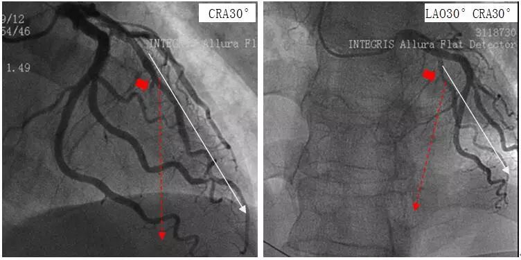 (2)如心脏位置正常(不是横位心),cra30°时前降支垂直走向,lao30°cra