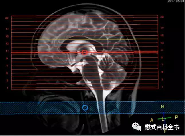 神經影像腦灌注成像磁共振asl技術基本原理及臨床應用一