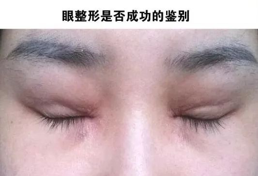 失败的双眼皮如何修复