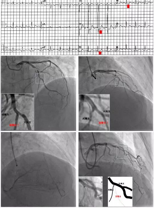 a為心電圖;b左冠造影,前降支除近段狹窄80%外,中遠段較小,走向怪異,但