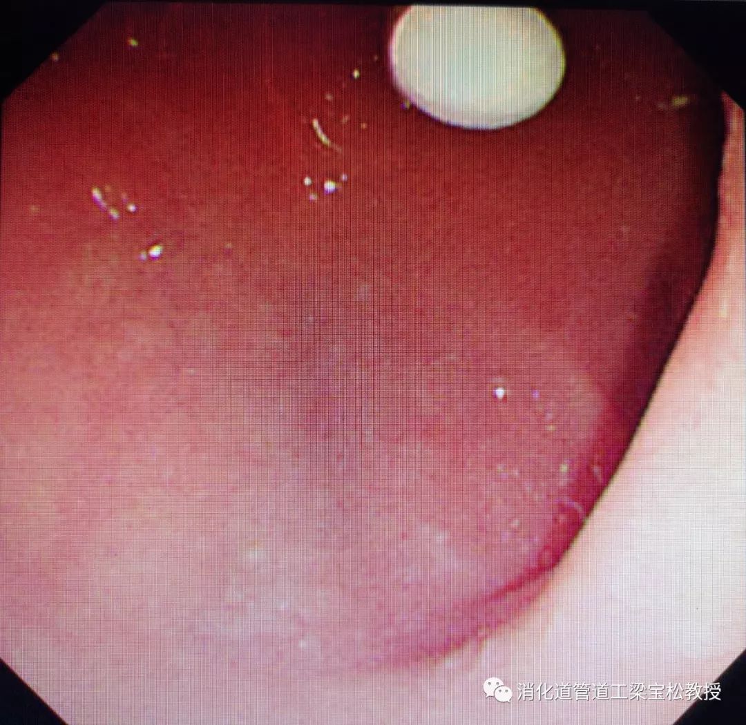 那个在十二指肠球部的药片,跟不够清晰?