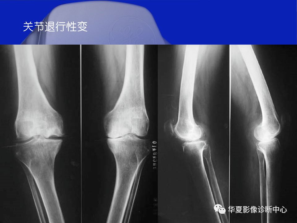 骨膜炎x光图片图片