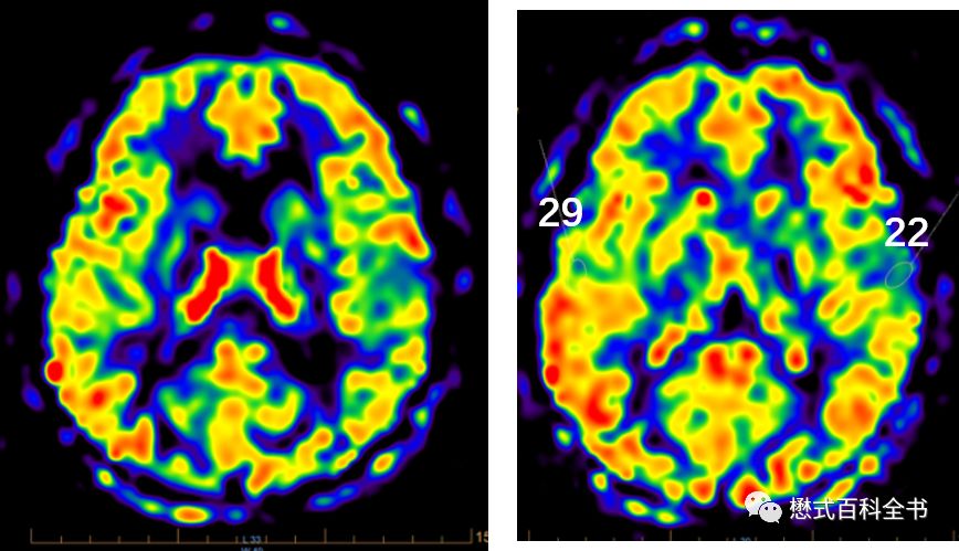 神经影像脑灌注成像磁共振asl技术基本原理及临床应用一