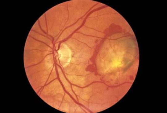 健康看东西模糊变形重影别不当回事小心5大致盲眼病在作祟糖尿病高