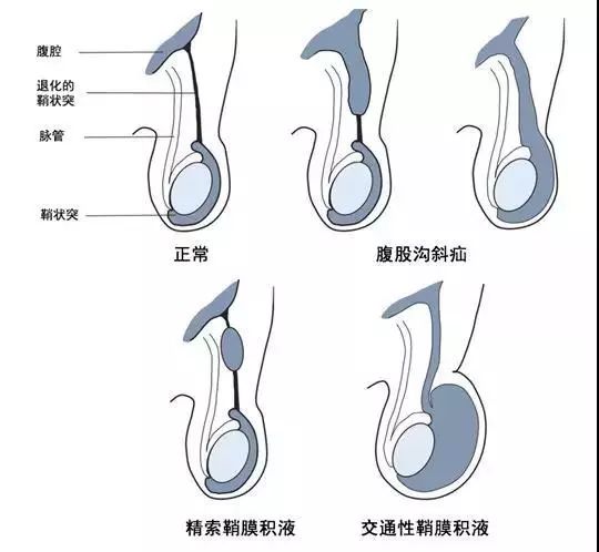 蛋蛋的忧伤——小儿腹股沟疝气_治疗