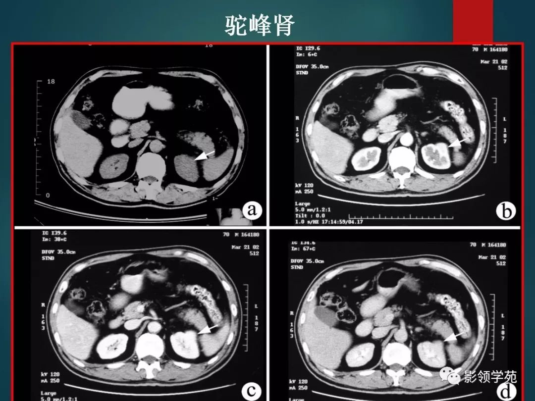 21种泌尿系统先天发育异常影像表现