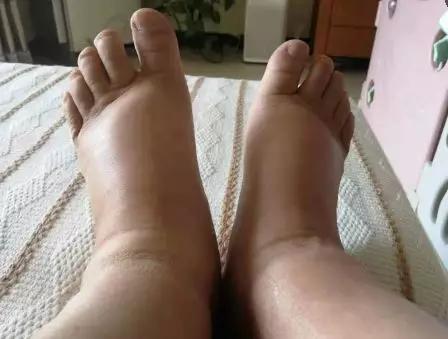 尿毒症除了肾移植或终生透析中医针灸也能治愈