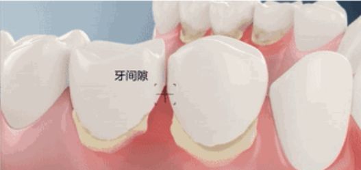 一咬就出血这是牙龈在求救