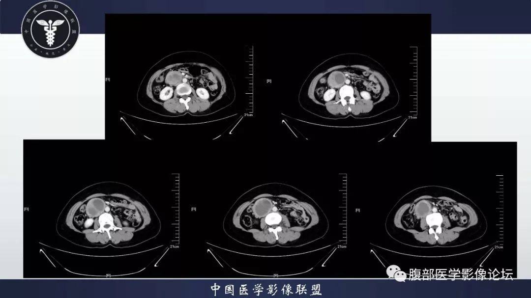 腹膜後間隙是壁腹膜和腹橫筋膜之間的解剖間隙及其解剖結構的總稱,是