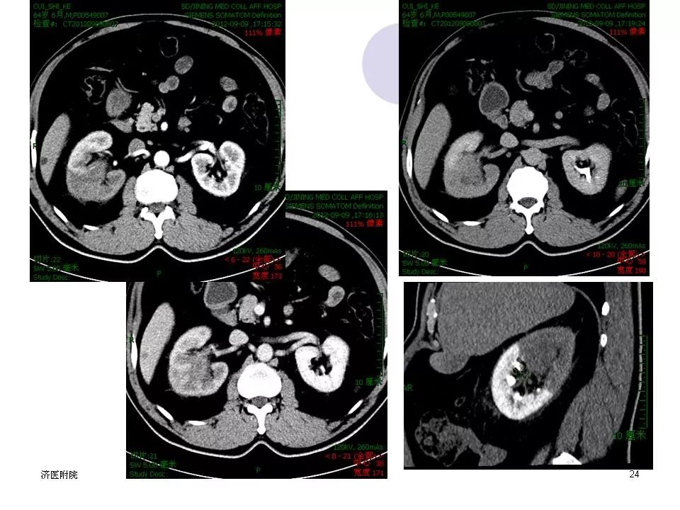 肾盂癌影像诊断丨影像天地