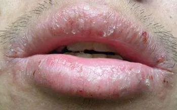 99天然成分拯救你秋季唇干唇裂一抹死皮哗哗掉