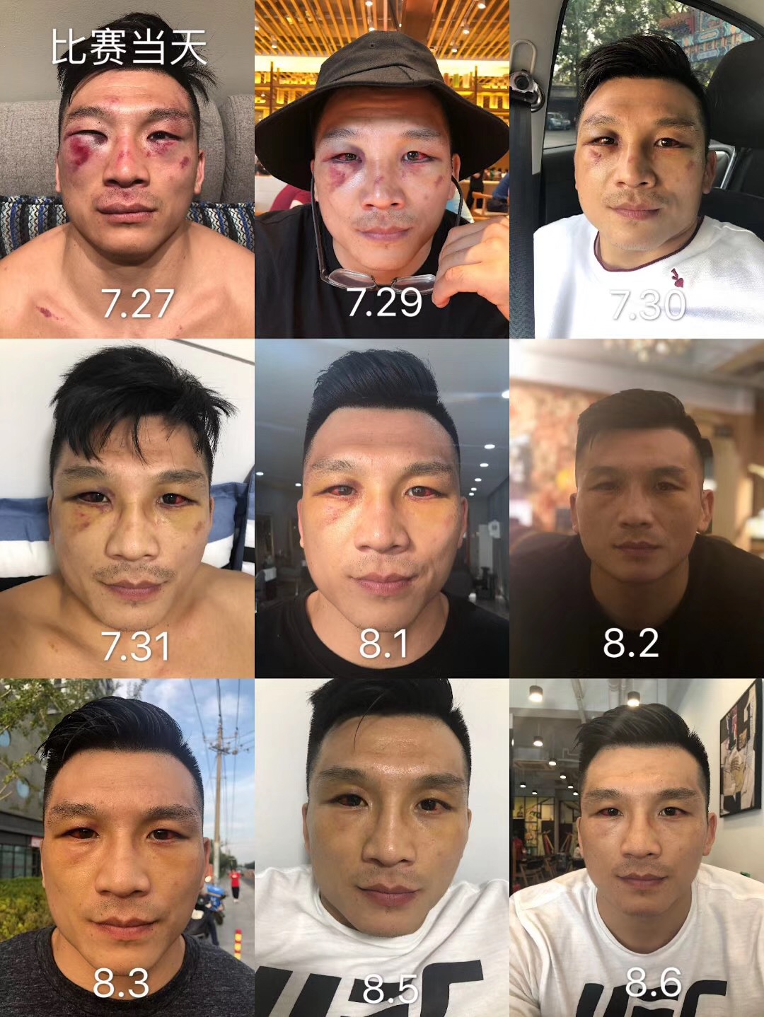 决最能打的拳王受伤严重,在京遭世界拳王挑战虽打赢却伤势重_张立鹏