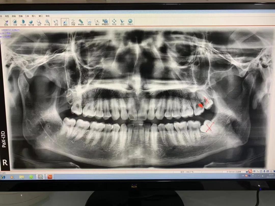 几乎所有人都有这个口腔问题危害巨大却没人当回事高新华怡口腔