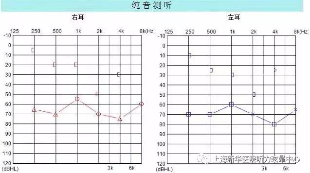 耳硬化症纯音测听图图片