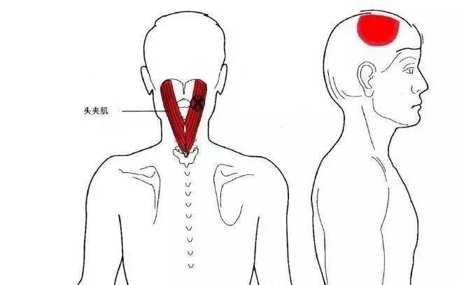 颈夹肌激痛点图片