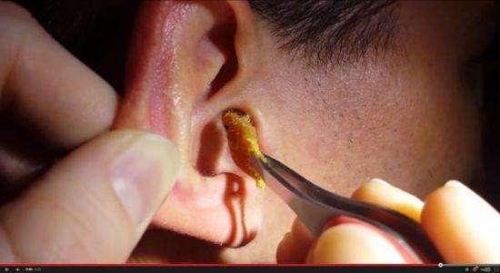 耳屎块状和油状究竟有何区别看完就知道多久掏一次耳朵