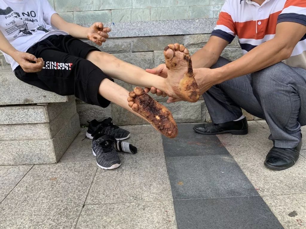 广西15岁少年患"树人"怪病,手脚长出"树皮状"硬块.