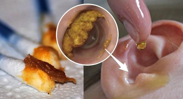 耳屎块状和油状,究竟有何区别?看完就知道多久掏一次耳朵_耳道