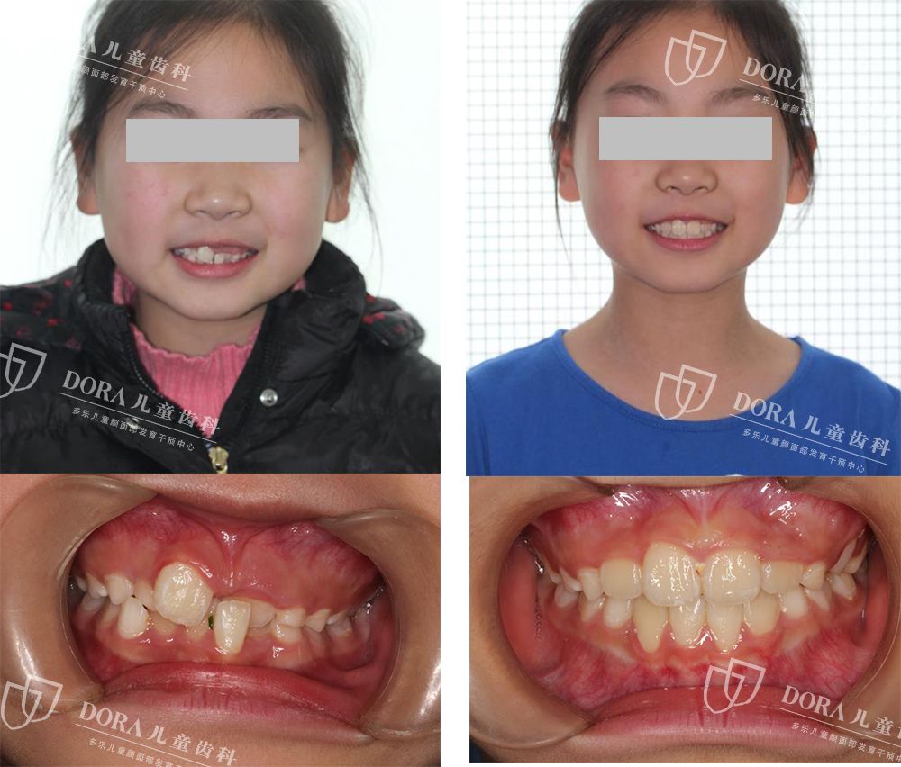 不仅会分享国外儿童牙齿矫正的实践还会通过多年来的临床矫正病例分析
