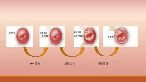 每年有3万女性因"它"死亡,且数据还在猛增中,高发年龄为45-59岁!