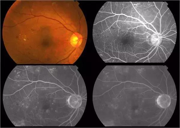 成年人近视还会加深吗