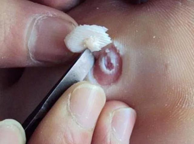 脚底板长的这个是老茧还是鸡眼小心还有可能是跖疣