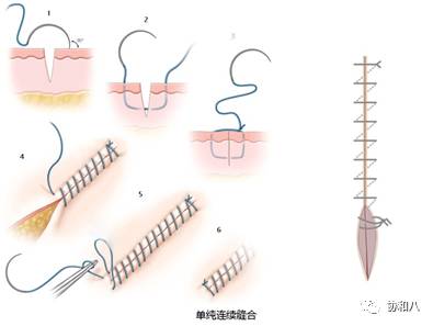 与单纯间断缝合相比,此方法打结数少,耗时短,更快速对齐伤口,不易留