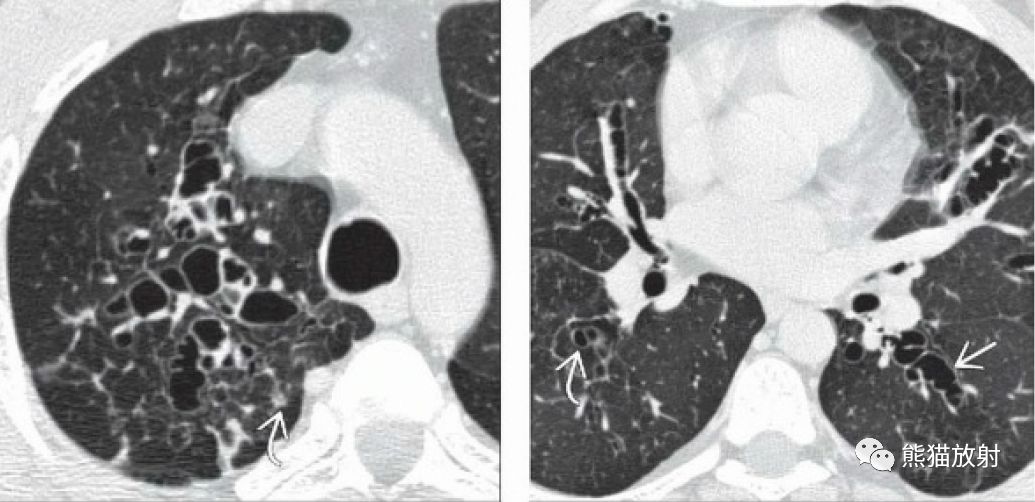 徵)支氣管擴張,部分肺不張及實變氣道內黏液栓鑑別診斷:囊性纖維化