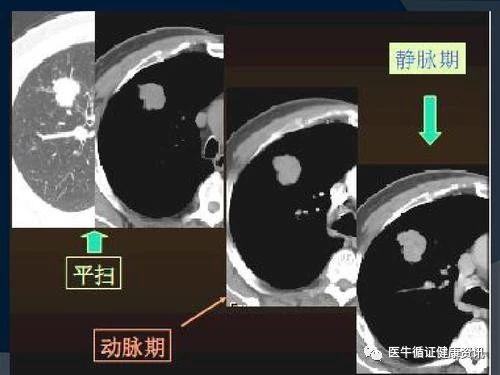 的一些常見病,多發病,比如肺炎,慢性支氣管炎,肺氣腫,肺結核,胸膜炎