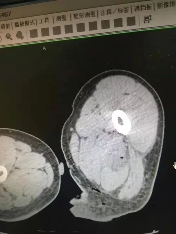 我院成功抢救坏死性筋膜炎重症感染脓毒血症患者