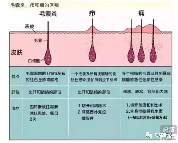 痈,则是比疖更严重的一个疖病,患部浸润明显,表面有多个脓头,形成蜂巢