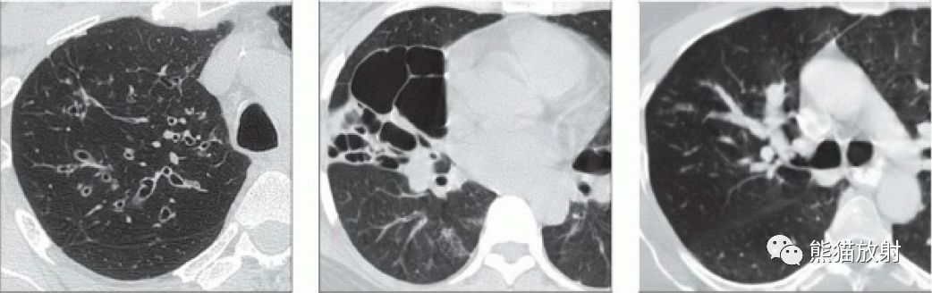 变应性支气管肺曲霉菌病丨ct表现,诊断要点_扩张