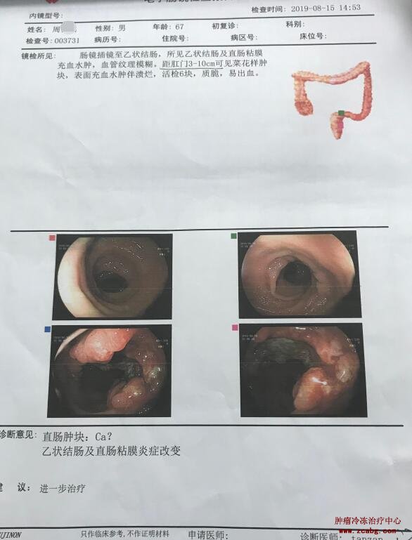 大便粘液图片直肠癌图片