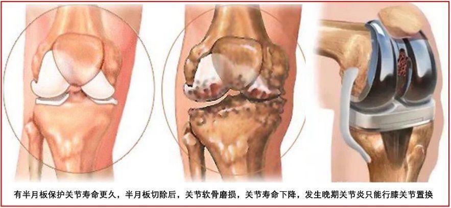 求实瑜伽丨私教必备膝关节半月板损伤的评估理疗