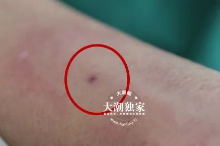 警惕被马蜂蛰了涂风油精会要命这种错误大多数人还在犯