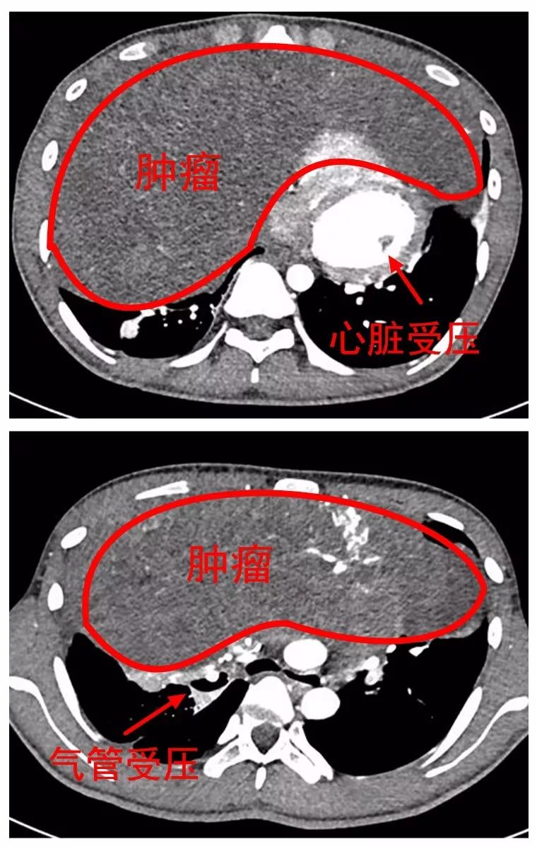 心脏癌的图片图片