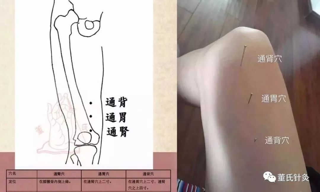 董氏针灸林正泰案例分享之通肾通胃通背穴