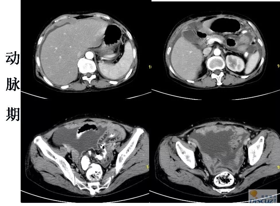卵巢癌,等你分析丨读片专栏1171期_检查