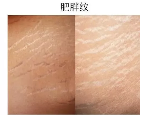 这是因为皮下脂肪剧烈减少,皮肤发生皱缩.