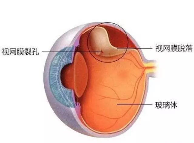 視網膜脫落是怎麼回事絕大部分人可能都不清楚