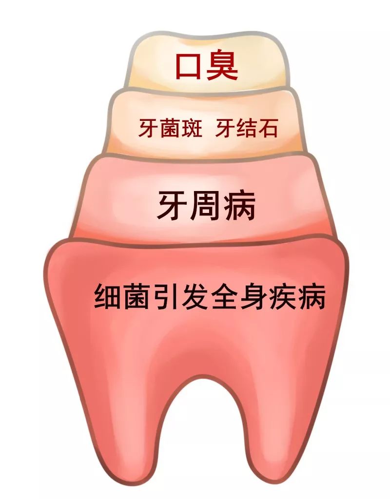 如果患上牙結石是需要定期洗牙的而洗牙又要進行全身麻醉整個過程對於