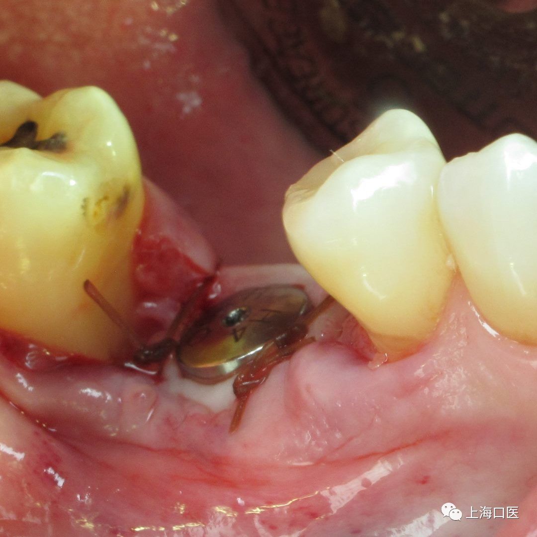 下颌单颗磨牙缺失种植,gbr cgf膜,用舌下切口切除角
