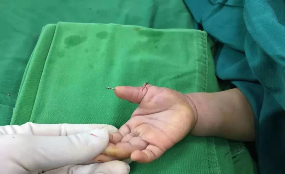 "六指儿"究竟是怎么回事呢?六指是一种病吗?且听人医君慢慢道来.