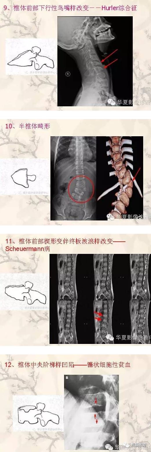 腰椎双边征影像表现,颈椎双边征影像