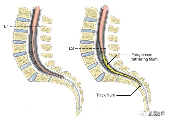 终丝脂肪沉积,典型病例不能错过