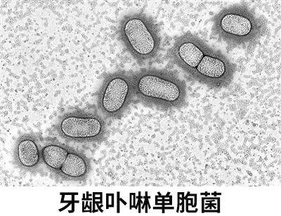 圣贝牙科教授告诉你牙周炎细菌侵入血液致老年痴呆胃病癌症统统找上门