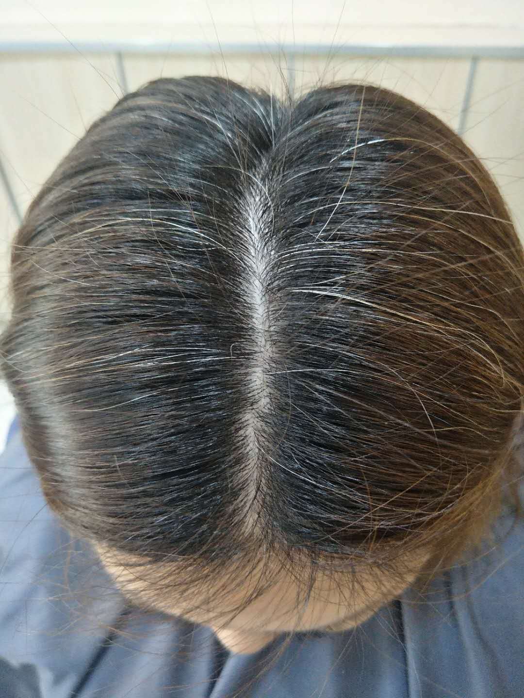 岳灵生发案例产后白发增多