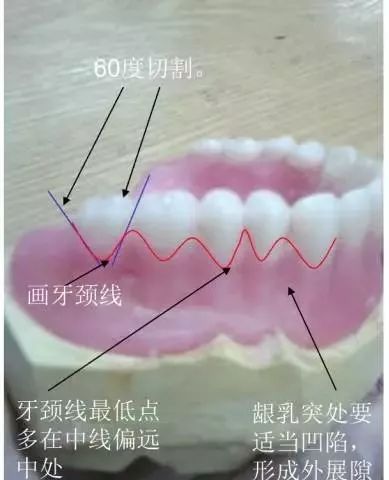 牙齿的外展隙图解图片