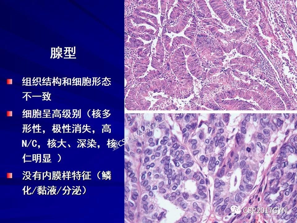 中華病理學會基層培訓遵義站講座(五)——子宮內膜癌和內膜增生症的