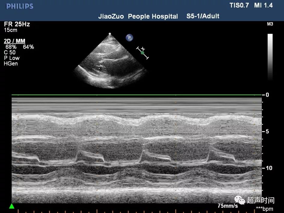 二尖瓣狭窄超声图片